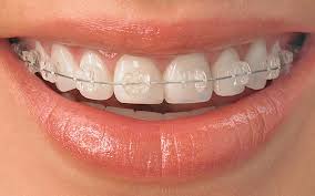 best orthodontic treatment in Bangalore
